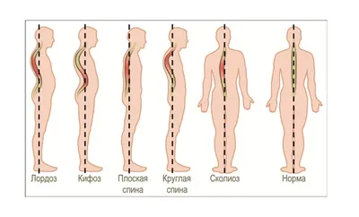 Сколиоз: степени искривления позвоночника и грудопоясничного отдела,  причины, симптомы, лечение в клинике Константа в Ярославле
