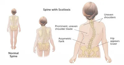 Сколиоз: виды, причины, лечение - KinesioPro