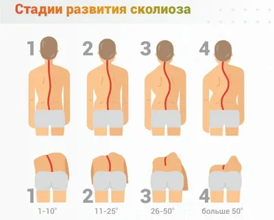 Сколиоз: причины, лечение, профилактика