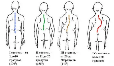 Лечение сколиоза у взрослых и детей в клинике остеопатии в Москве.