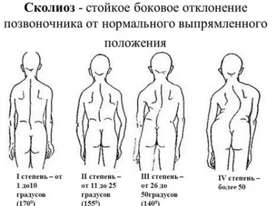 Лечение сколиоза в Израиле | Герцлия Медикал Центр