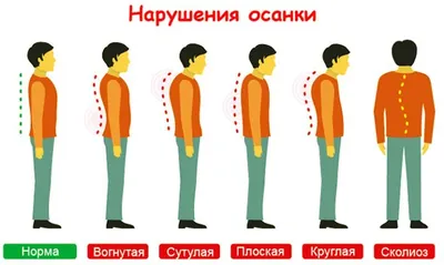 Сколиоз, виды искривления позвоночника у детей и взрослых, лечение сколиоза  в Москве
