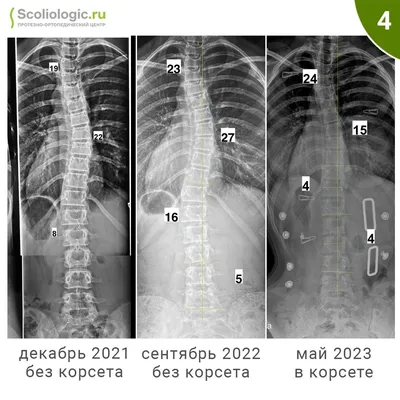 Сколиоз: этиология, классификация, диагностика, лечение - Vertebra