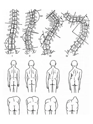 Лечение сколиоза II степени | Протезно-ортопедический центр | Дзен