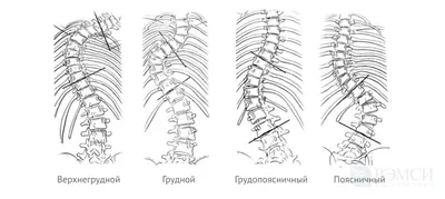 Искривление позвоночника лечение, сколиоз