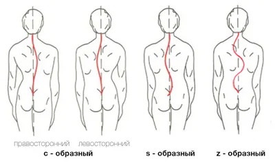 Сколиоз: этиология, классификация, диагностика, лечение - Vertebra