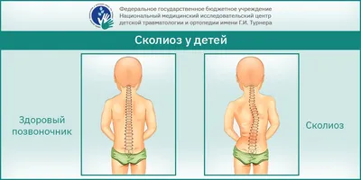 Лечение сколиоза и коррекция осанки в Алматы