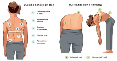 Сколиоз: фото, 1, 2, 3 и 4 степени, у детей, лечение, упражнения