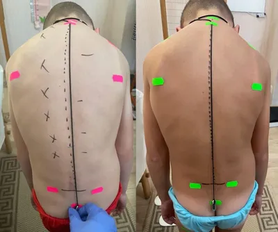 Идиопатический правосторонний сколиоз 2-3 и 4 степени - операция в клинике  лечения позвоночника SL-Клиника