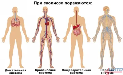 Сколиоз у взрослых и детей, симптомы, степени, диагностика, причины  заболевания и лечение в ЦИТО, Москва