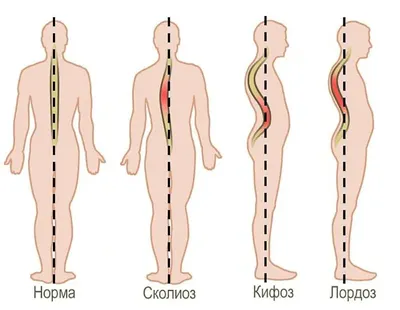 СКОЛИОЗ позвоночника 1, 2, 3 и 4 степени у детей и взрослых - симптомы,  причины, диагностика |  | Дзен