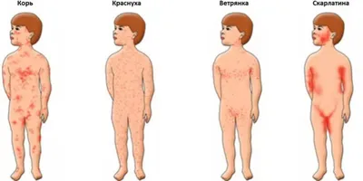 Аллергическая сыпь на лице, руках, теле - основные причины, потенциальные  болезни, лечение