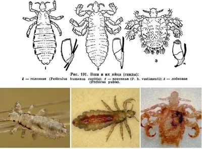Виды вшей картинки