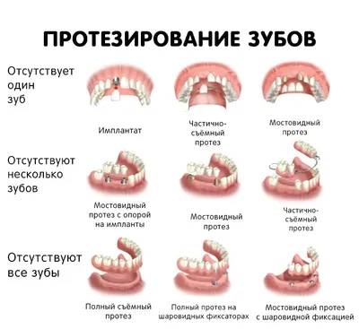 🦷 Протезирование зубов ☑ Стоматология в Киеве и Львове ☑ Giorno Dentale