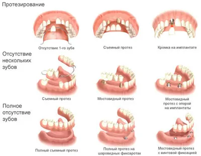 Съёмное протезирование зубов в Минске - поставить съёмный зубной протез