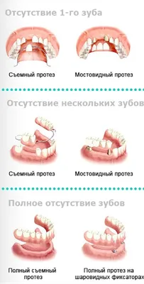 Протезирование зубов в стоматологической клинике "Доктор Про"