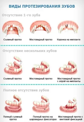Протезирование зубов: виды зубных протезов, плюсы и минусы