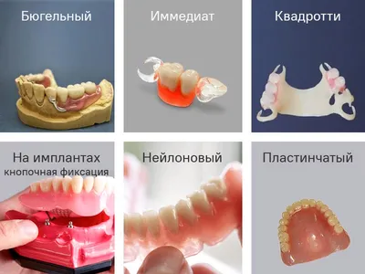 Протезирование зубов в Минске, низкие цены протезирования в Беларуси