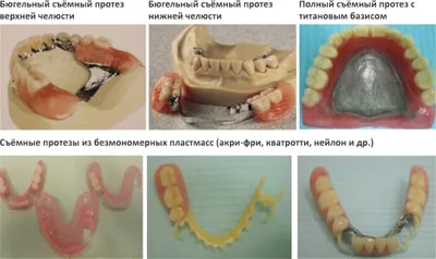 Виды съемных зубных протезов | Клиника Колибри