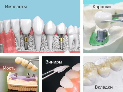 Зубные протезы в спб нового поколения: акция, цены на все виды зубных  протезов в Санкт-Петербурге