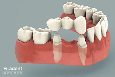 Протезирование зубов виды и цены