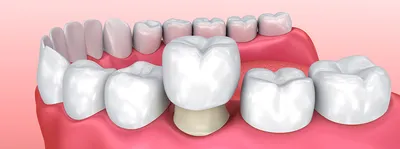 Протезирование верхних зубов, варианты и стоимость от 12 000 ₽