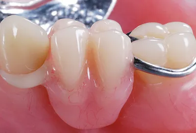 Виды зубных протезов картинки