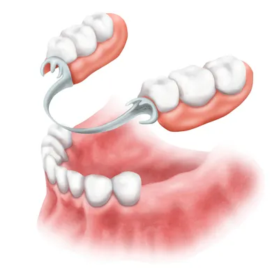Вставные зубы – протезирование, имплантация