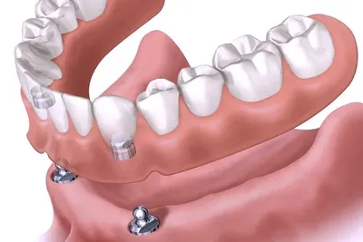 Съемные протезы на верхнюю челюсть: положительные качества искусственных  зубов - Новости и статьи