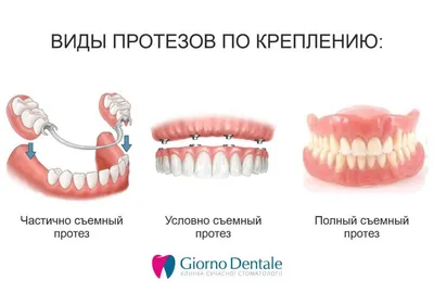 Съемные зубные протезы по низким ценам - Краснодар. Стоимость на частичное  и полное съемное протезирование