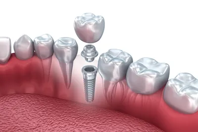 Протезирование зубов в Курске – цены на зубные протезы в Doctor Smile