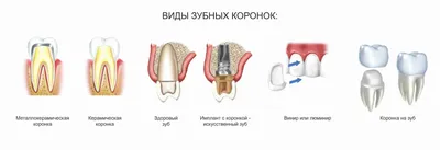 Что такое съемный зубной протез: виды и классификация | Silk
