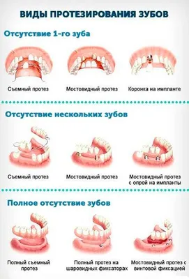 🦷 Протезирование зубов ☑ Стоматология в Киеве и Львове ☑ Giorno Dentale