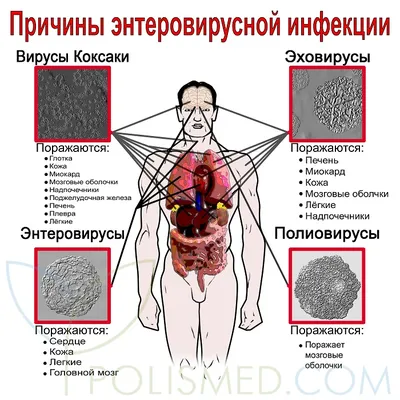 Вирус Коксаки - причины появления, симптомы заболевания, диагностика и  способы лечения