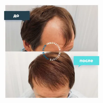 Лечение выпадения волос в Саратове - центр красоты и здоровья Le Stelle  (Саратов)