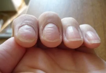 Какие бывают заболевания ногтей | Мир красоты | Дзен