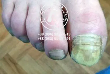 Грибковое заболевание ногтей (онихомикоз).лечение грибкового заболевания  ногтей в Днепропетровске. Врач-подолог Днепропетровск Украина