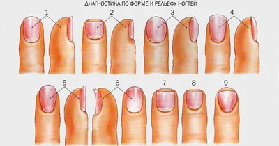 Грибковое заболевание ногтей (онихомикоз).лечение грибкового заболевания  ногтей в Днепропетровске. Врач-подолог Днепропетровск Украина