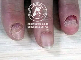 Лазерное лечение грибка ногтей - Bilyk Ultra Laser — лазерна  дермато-косметологія