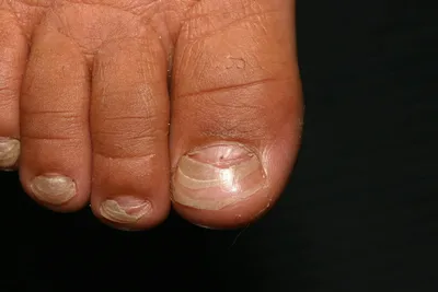 Фотодинамическая терапия в лечении грибковых заболеваний ногтей