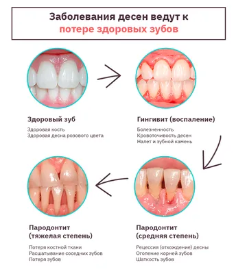 Важный этап лечения воспаления десен – чистка зубов у стоматолога