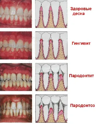 Какие бывают заболевания десен?