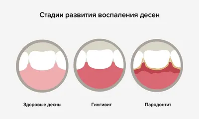 Заболевания десен у детей