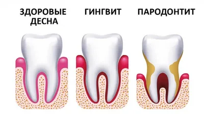 Лечение и профилактика дёсен