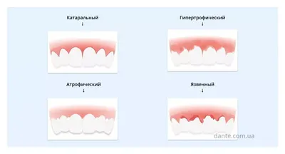 Профилактика воспаления десен - рекомендации от стоматологов