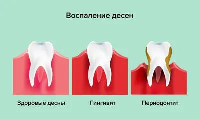 Причины и симптомы воспаления десен