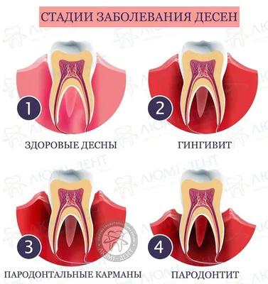 Симптомы и признаки воспаления десен