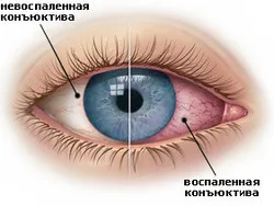 Болезни глаз | «Линзмастер» – крупная сеть салонов оптики | Дзен