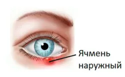 Опухолевые заболевания глаз