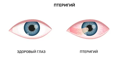 Глазные заболевания у человека список, симптомы - Центр микрохирургии глаза  «Окулюс» - Липецк